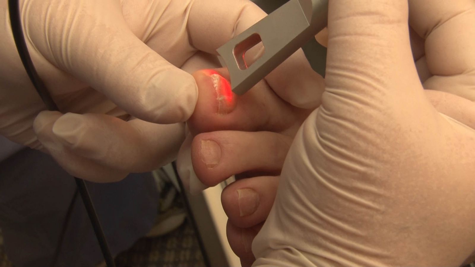 Лазерная терапия грибковых заболеваний ногтей